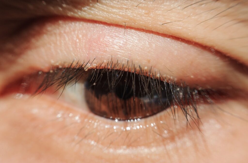A close-up of an eye with blepharitis showcasing the symptoms of this infection