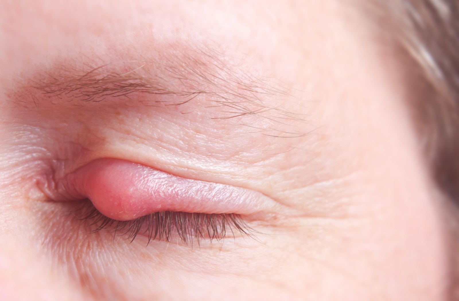 A person closes their eye tightly in discomfort. They have a large, inflamed eye stye on their upper eyelid.